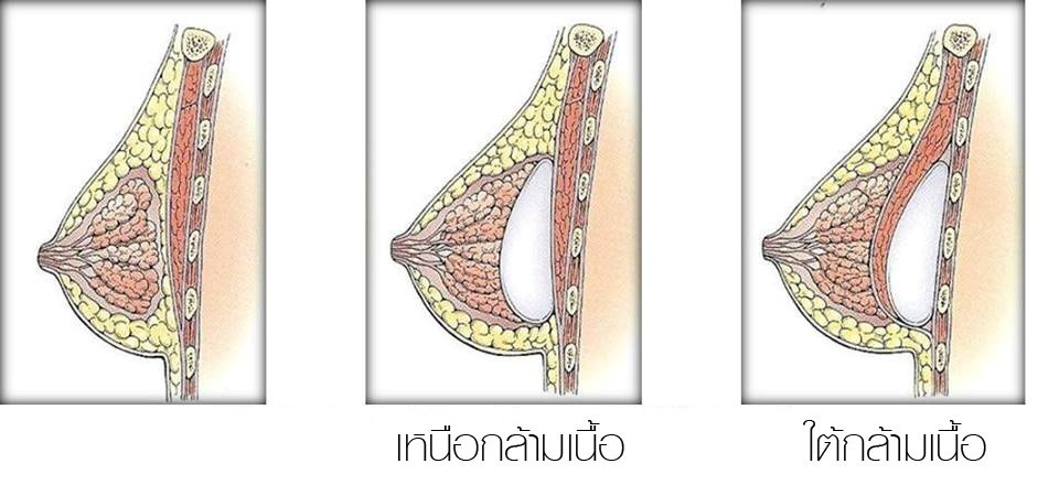เสริมหน้าอก