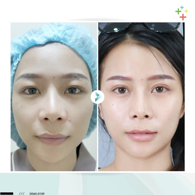 รีวิวทำตาสองชั้น สวยปัง ไม่ต้องพักฟื้นจากหมอรวงข้าว