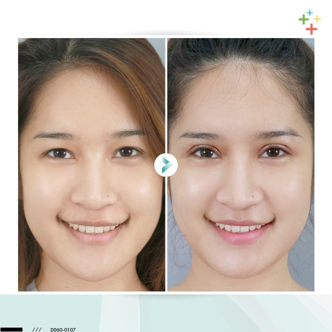 รีวิวทำตาสองชั้น สวยปัง ไม่ต้องพักฟื้นจากหมอรวงข้าว