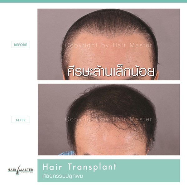 ปลูกผม