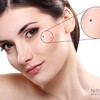 Melasma-therapy