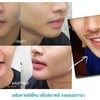 เสริมคางซิลิโคนเกาหลี ปรับรูปหน้าให้ดูเรียวแบบเป็นธรรมชาติ