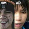 ขจัดสิวและยังทำให้ฝ้า กระ จุดด่างดำจางลง