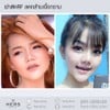 ผ่าตัดRF ลดกล้ามเนื้อกราม