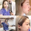 รีวิวเติมไขมันหน้าผากหลังทำทันทีค่ะ