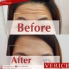 botox ลดเลือนริ้วรอย เห็นผลชัดเจน ตึงใน 2-3 อาทิตย์ ไม่ตึงทางคลินิกยินดีบริการฟร