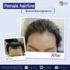 Female Hairline