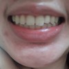 จัดฟันแต่ฟันยังทุเรสไม่สวย ฟันหน้าเฉียงไม่สบ ฟันซี่ขวาจากในรูปคือใส่ฟันซี่ละ6000
