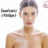 รักษาด่างขาว (Vitiligo) ในโคราช & บุรีรัมย์ แอลซีคลินิก