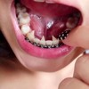 อุปกรณ์กันลิ้นดันฟันสำหรับคนจัดฟัน (Tongue guard)