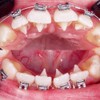 อุปกรณ์กันลิ้นดันฟันสำหรับคนจัดฟัน (Tongue guard)