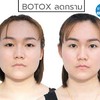 ฉีดโบท็อกลดกราม หน้าเรียว สวยดั่งใจ จากรักษ์คุณคลินิก