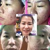 ลูกค้ากดสิว ควบคู่กับการใช้ครีม #มาดามกิ้กกี้ ทุกตัว100%