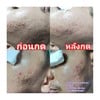 มีปัญหาสิว หมดหนทางรักษา ทักมาปรึกษาเราได้ค่ะ