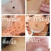 มาอีกแล้วค่ะ คราวนี้มาจี้กระเนื้อ กระสีค่ะ เลเซอร์เบาๆ แบบว่าแอบกลัวเจ็บ ขออาจ