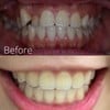 นี่คือฟันของเราก่อนที่จะเข้ารับการรักษา เเละหลังเข้ารับการรักษา เปรียบเทียบให้ดู