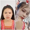 ก่อน - หลัง ทำตาสองชั้น