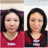 ฉีดโบท็อกซ์ (Botox) ลดกรามลดริ้วรอย + ฉีดเมโสแฟทที่แก้ม