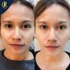 Before / After Smart ST Lifting