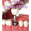 รากเทียมโดยทันตแพทย์เฉพาะทาง ราคา39000-45000บาท