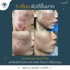 รีวิวเด็ด ดูแลกันมา5เดือน ผิวดีขึ้นอย่างต่อเนื่อง ลูกค้าปลื้ม เราก็ปลื้มใจ😍