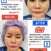 Review ก่อนและหลังเมื่อเติมไขมันหน้าเด็ก (หลังทำทันที) ย้วนวัยขนาดไหน ชมความปังไ