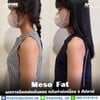 รีวิวฉีดแฟตลดไขมันต้นแขน
Meso Fat มีประสิทธิภาพในการลดไขมันได้อย่างรวดเร็วและปลอ