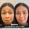 💗Botox Hugel Premium (เกาหลี) 🇰🇷
โบท็อกริ้วรอยทั่วหน้า
ตัวยาทุกตัว อย.ไทยแท้ 