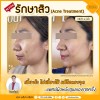 𝐑𝐄𝐕𝐈𝐄𝐖 รักษาสิวที่ต้นเหตุ หลังทำ 4 ครั้ง