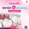 ครอบฟันเซรามิก