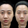 เปรียบเทียบ before-after