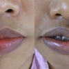 เป็นคนปากหนา ไม่เป็นทรง ดูมาหลายที่จนตัดสินใจมาทำปากกับทางbetter me Clinic ชอบ ท