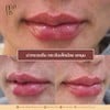 ฟิลเลอร์ปาก