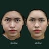 เปรียบเทียบก่อนฉีดกับหลังฉีด แก้มยกกระชับขึ้นอย่างเห็นได้ชัด