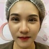 อันนี้ครบเจ็ดวันแล้วค่ะถือว่าค่อนข้างหายบวมไวเลยเพราะว่าตอนทำใช้เวลาทำค่อนข้างนา