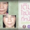 รีวิวการเติมไขมันบนใบหน้า