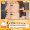 รีวิว ฉีดโบท็อกซ์ลดริ้วรอย ที่ เดอะ พรีม่า คลินิก