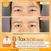 รีวิว ฉีดโบท็อกซ์ลดริ้วรอย ที่ เดอะ พรีม่า คลินิก