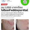 โปรแกรมรักษาสิวของมาลินีคลินิก ครบ คุ้ม จบ ในราคา 1,555 ต่อเดือ