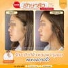 รีวิว หลังรักษาสิว 4 ครั้ง