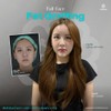 Facial Fat Grafting เติมไขมันหน้าเด็ก 