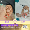 ผ่าตัดคีย์ลอยด์หู...!! เจ็บนิดเดียว แต่ผลลัพธ์คือโครตคุ้มที่ W⁺ Medic Clinic นนท