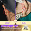 ประสบการณ์ผ่าตัดคีลอยด์หูที่ W⁺ Medic Clinic นนทบุรี ก่อนและหลังผ่าตัด!