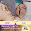 ผ่าคีลอยด์หูแบบเรียลไทม์!ที่ W+medic Clinic นนทบุรี รู้เลยว่าทำไมคนแนะนำเยอะ!