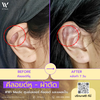 ผ่าตัดคีลอยด์หู หลังผ่านไป 7 วัน ดีเกินเบอร์! ที่ W⁺ Medic Clinic นนทบุรี