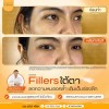 รีวิวหลังฉีดฟิลเลอร์ใต้ตา ทันที