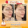 รีวิวก่อนทำ และ หลังรักษาสิว 3 ครั้ง