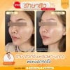 รีวิวก่อนทำ และ หลังรักษาสิว 3 ครั้ง