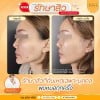 รีวิวก่อนทำ และ หลังรักษาสิว 3 ครั้ง