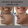 จัดฟันแบบไม่ผ่าตัดขากรรไกร